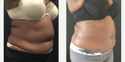 Smart Lipo before and after photo