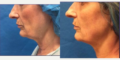 Thermage before and after photo