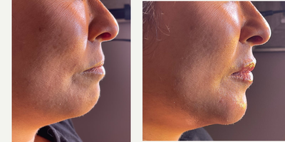 Chin Filler before and after photo