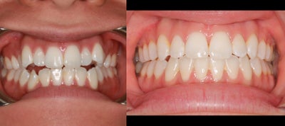 Clear Braces before and after photo