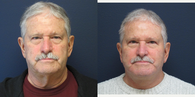 Facelift before and after photo