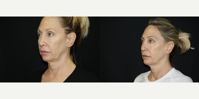 Infini RF before and after photo