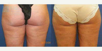 Smart Lipo before and after photo