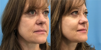 Voluma before and after photo