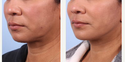 Chin Liposuction before and after photo