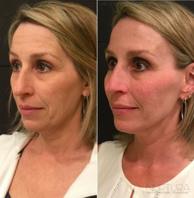 Dermal Fillers before and after photo