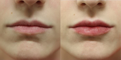 Juvederm before and after photo