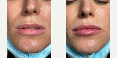 Lip Fillers before and after photo