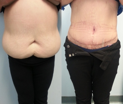 Liposuction before and after photo