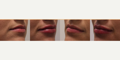 Restylane Silk before and after photo