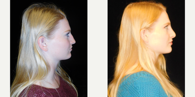 Rhinoplasty before and after photo