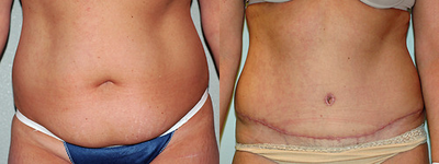 Tummy Tuck before and after photo