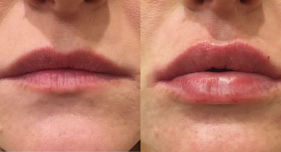 Vollure before and after photo