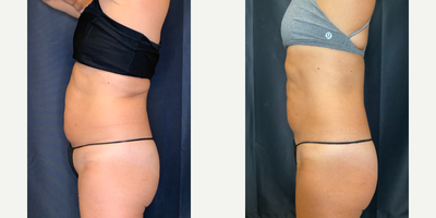 Emsculpt before and after photo