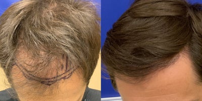 Hair Transplant before and after photo