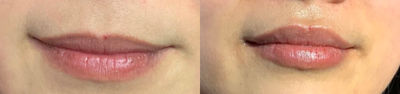 Lip Fillers before and after photo