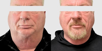 Liposuction before and after photo