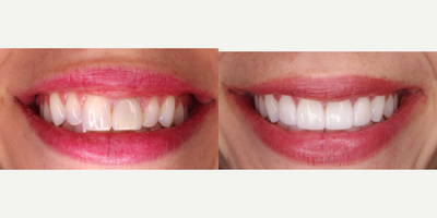 Porcelain Veneers before and after photo