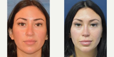 Rhinoplasty before and after photo