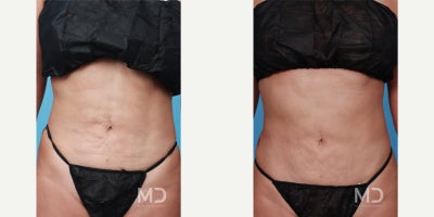 Tummy Tuck before and after photo