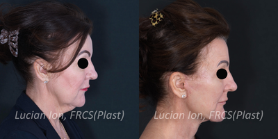 Deep Plane Facelift before and after photo