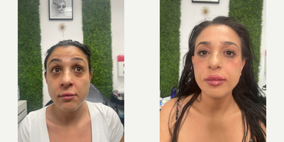Dermal Fillers before and after photo