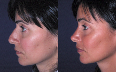 Rhinoplasty before and after photo