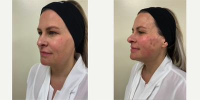 Silhouette Soft before and after photo