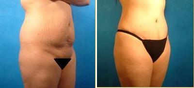 Brazilian Butt Lift before and after photo