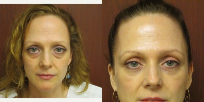 Eyelid Surgery before and after photo