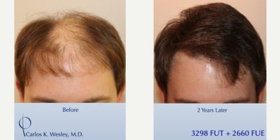 Hair Transplant before and after photo