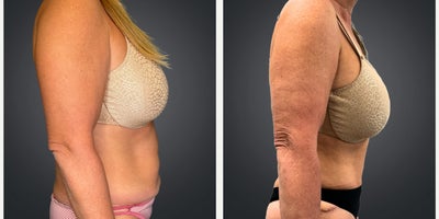 Liposuction before and after photo