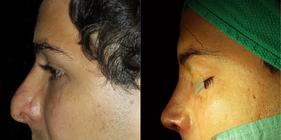 Rhinoplasty before and after photo