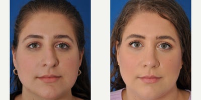 Rhinoplasty before and after photo