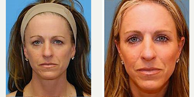 Brow Lift before and after photo
