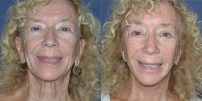 Facelift before and after photo