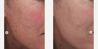 Fractional Laser before and after photo