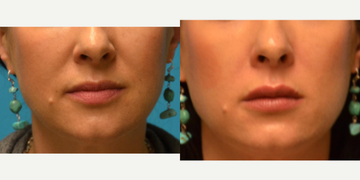 Juvederm before and after photo