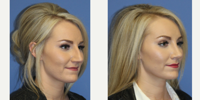 Rhinoplasty before and after photo
