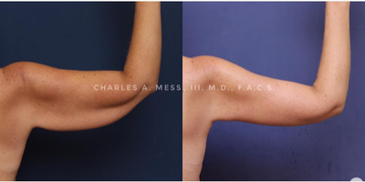 Arm Lift before and after photo