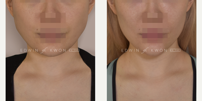Botox before and after photo