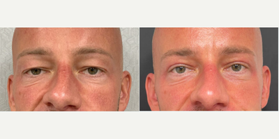 Eyelid Surgery before and after photo