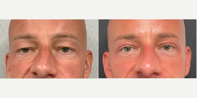 Eyelid Surgery before and after photo