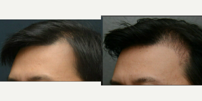 Hair Transplant before and after photo