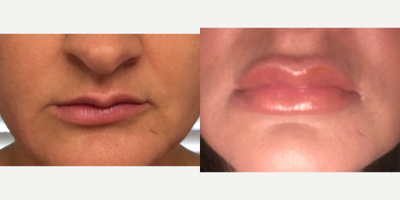 Juvederm before and after photo