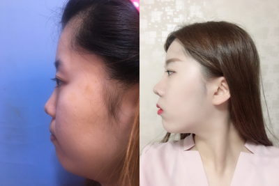 Rhinoplasty before and after photo