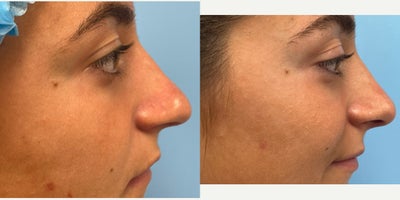 Rhinoplasty before and after photo