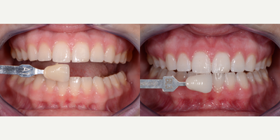Zoom Whitening before and after photo