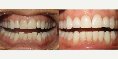 Braces before and after photo