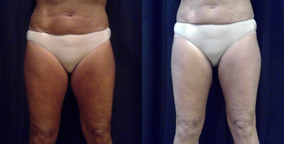 CoolSculpting before and after photo